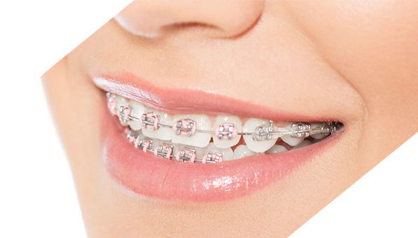 Nhs braces on sale