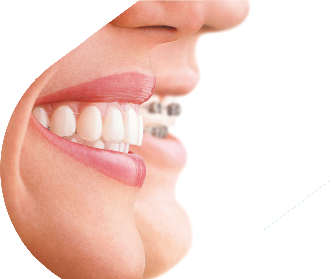 Invisalign Braces