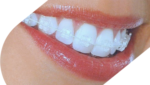 Invisible Braces Highland Orthodontic Practice Inverness