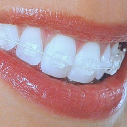 white braces